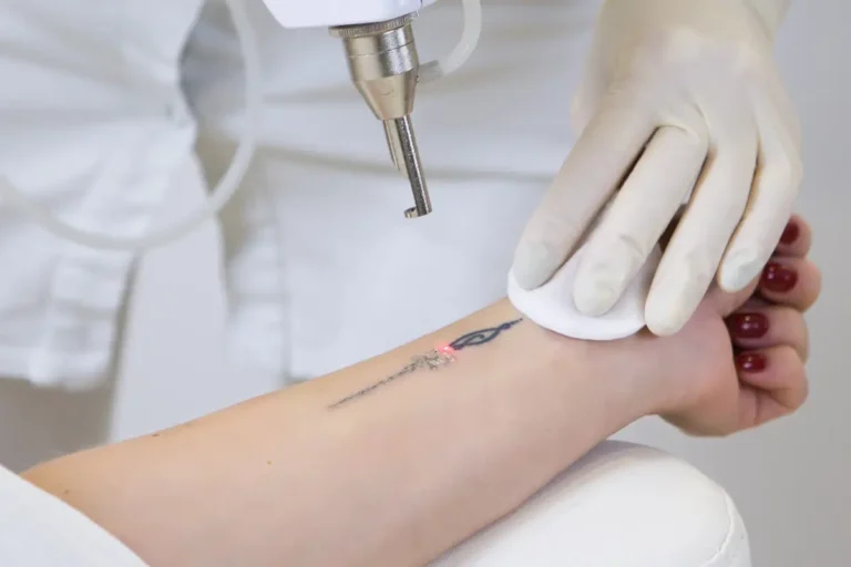 Lady getting laser tattoo removal treatment in bismarck, nd at Embrace Wellness