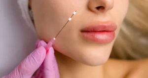 Women receiving PDO Threads In Bismarck, ND