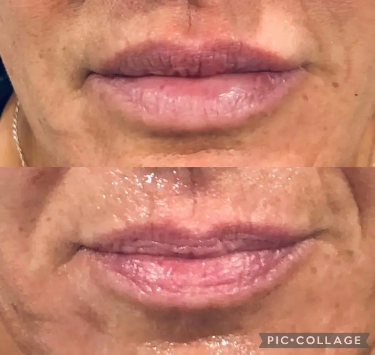 Restylane Juvederm Before and After Gallery