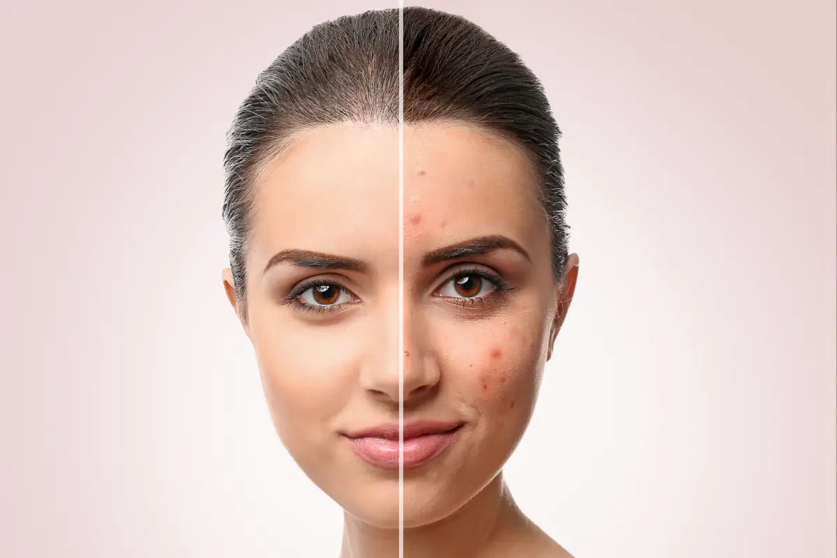 Woman before and after acne treatment | Embrace Wellness | Bismarck, ND