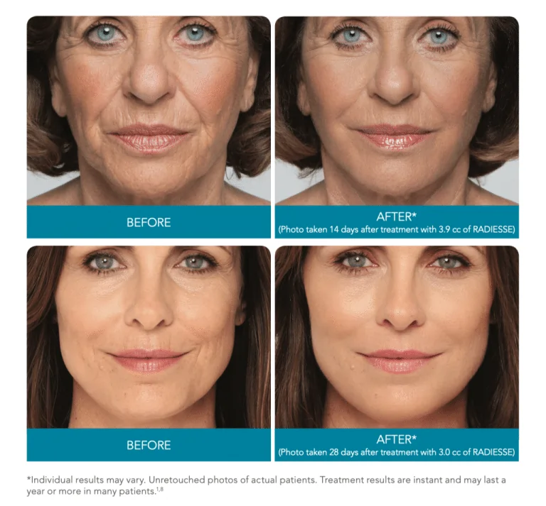 Woman Before and After Radiesse Treatment in Bismarck, ND | Embrace Wellness