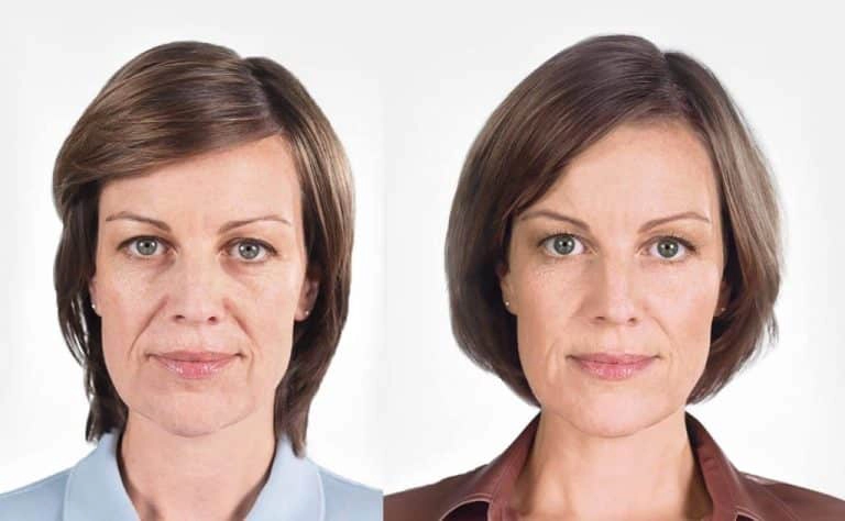 Sculptra Before and After | Embrace Wellness in Bismarck, ND