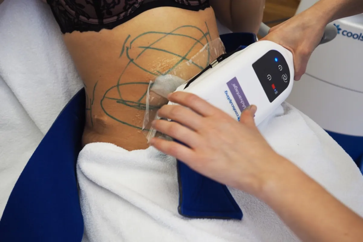 Woman Receiving Coolsculpting treatment in Bismarck, ND at Embrace Wellness